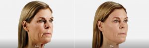 Voluma Facial Filler Before and After
